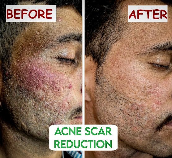Acne Scar Remove - Best Skin Specialist Udhampur