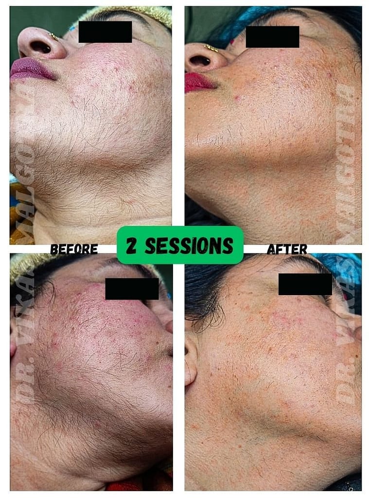 LASER Hair Removal Udhampur