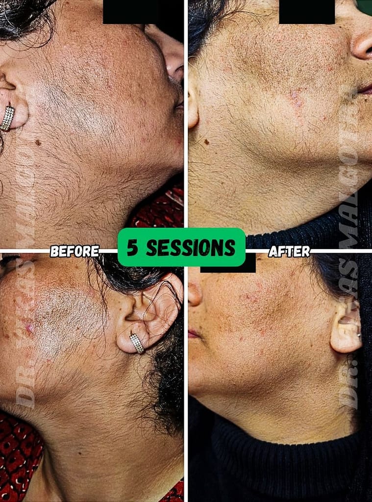 LASER Hair Removal Udhampur 2